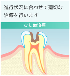 虫歯治療